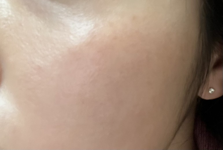 after photo: 피코토닝