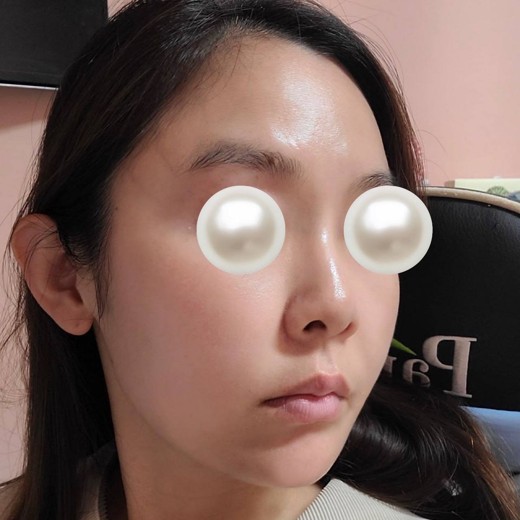 after photo: 울쎄라피프라임