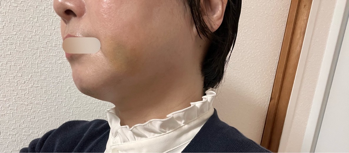 after photo: 脂肪溶解注射(太もも)