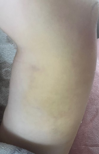 after photo: 脂肪吸引(腕)