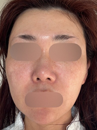 after photo: IPL(光/フォト治療), ルメッカ