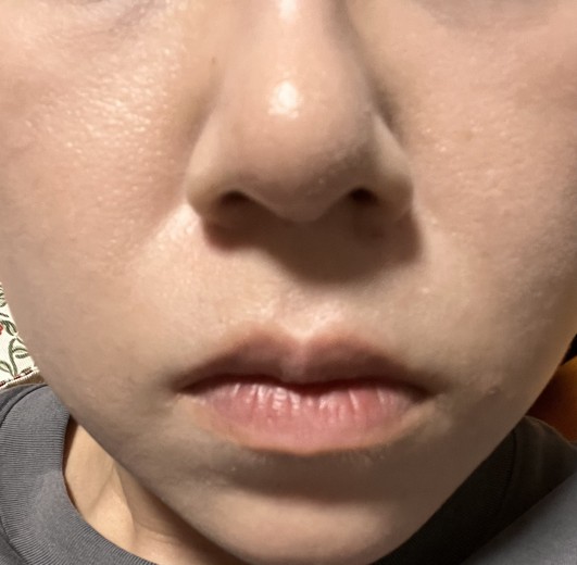 after photo: 脱毛(顔)