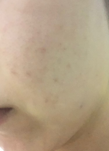 after photo: IPL(光/フォト治療)