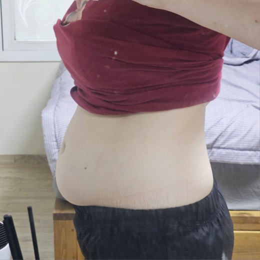 before photo: 러브핸들지방흡입, 복부지방흡입