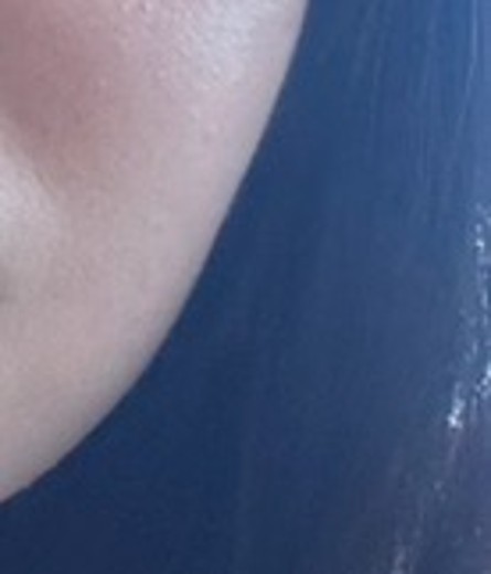 before photo: 윤곽주사