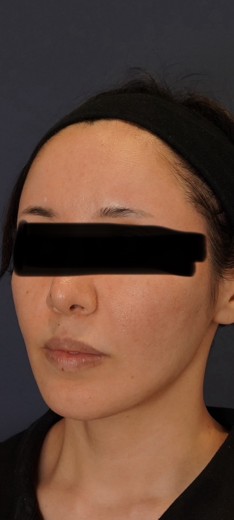 after photo: 高周波(RF)