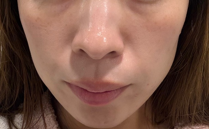 ケミカルピーリング｜全顔｜サリチル酸マクロゴール使用｜肌質改善基礎