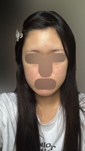 after photo: イオン導入