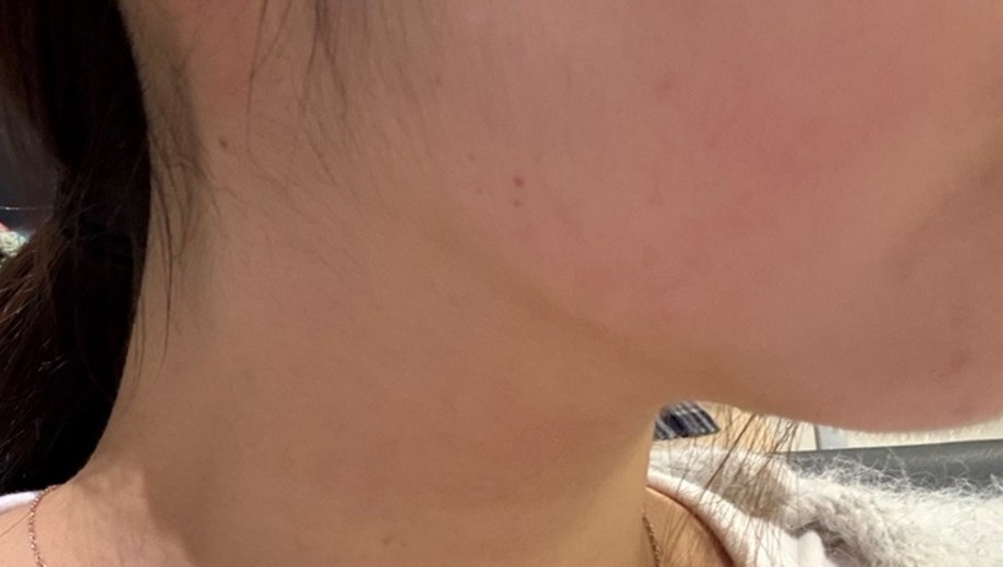 after photo: 윤곽주사, 사각턱보톡스