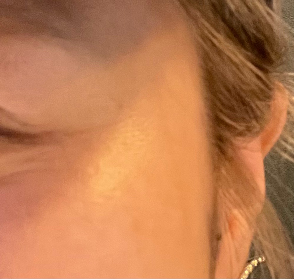 ボトックス | 柏の美容皮膚科ならBellis skin clinic, image size:1000x947