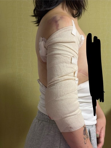 after photo: 脂肪吸引(腕)
