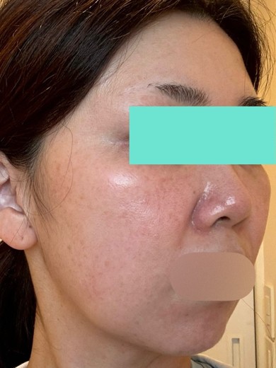 before photo: IPL(光/フォト治療), ルメッカ
