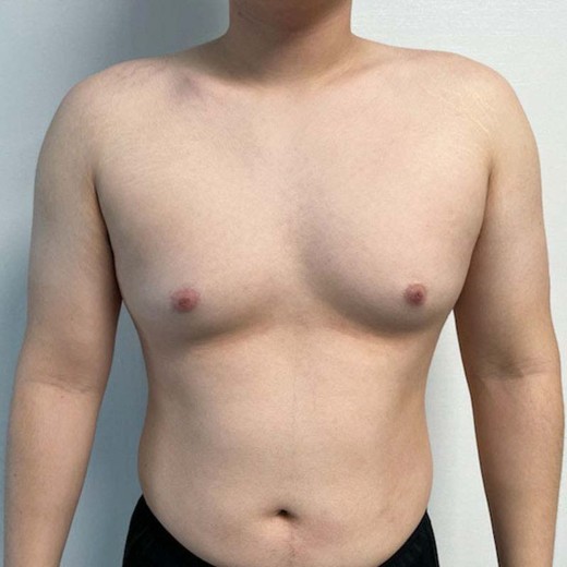 before photo: 여유증수술