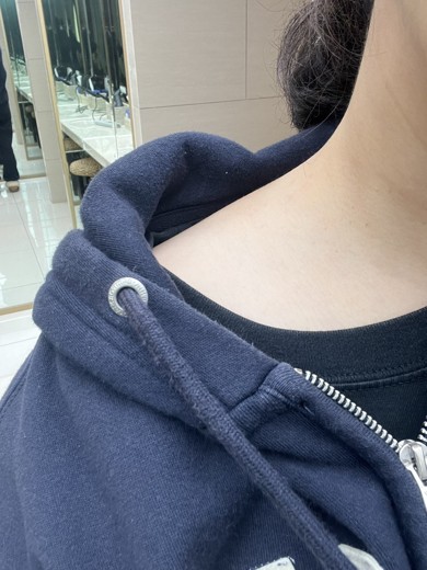 after photo: 승모근보톡스