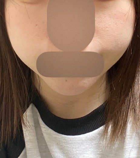 after photo: 脂肪吸引(顔)