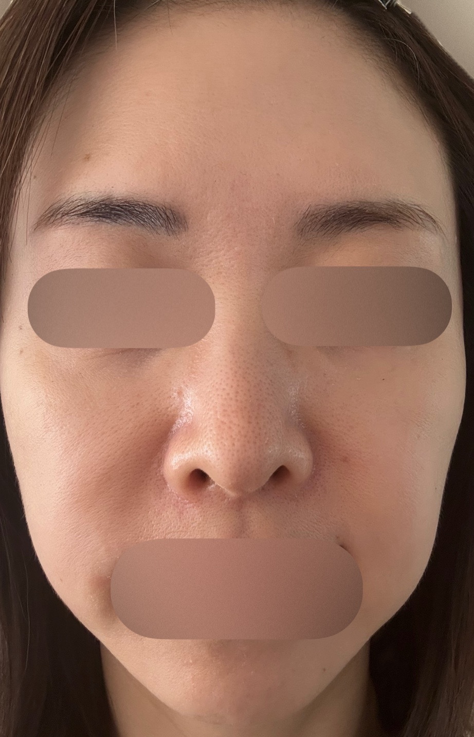 アクアピール＋エレクトロポレーション【薬剤代込】【再来OK