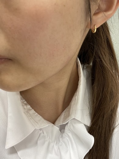 before photo: ピーリング, ルメッカ