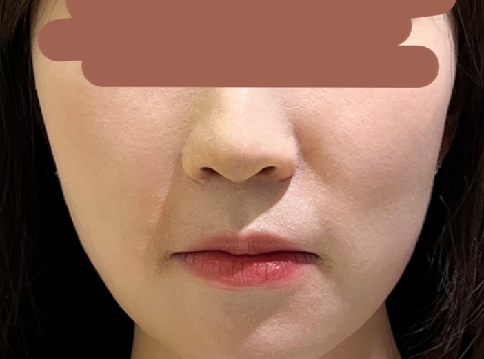 before photo: 팔자주름필러