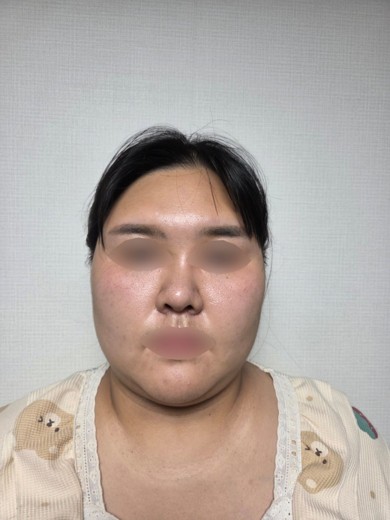 after photo: 비중격만곡증수술, 코끝(보형물)