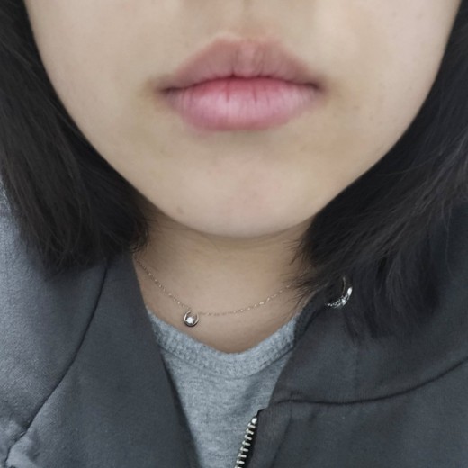 after photo: 사각턱보톡스, 튠라이너