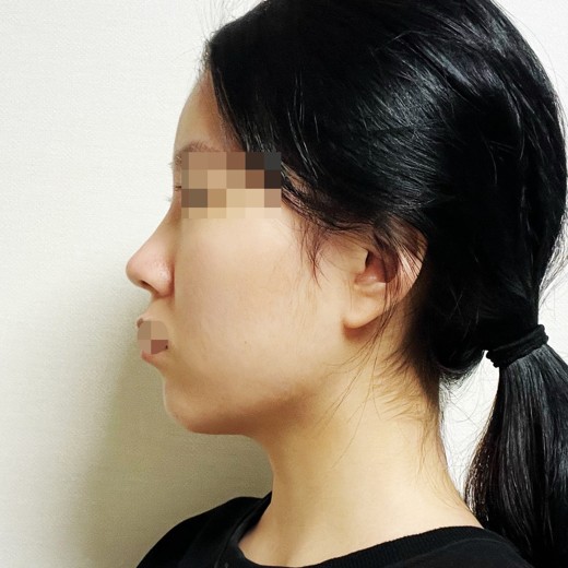 after photo: 코끝(자가연골)