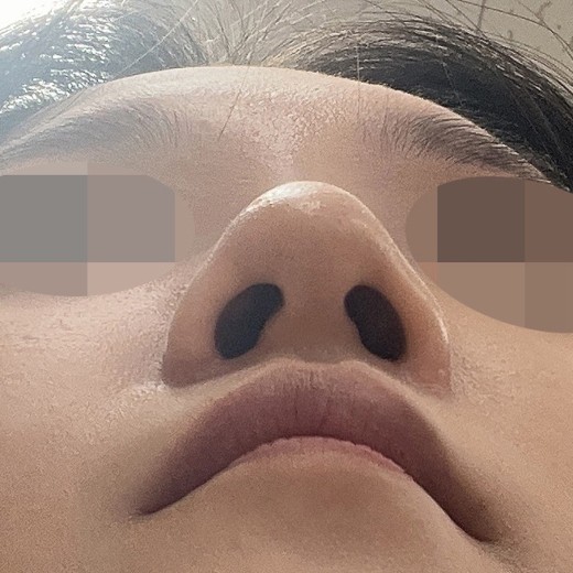 after photo: 콧볼축소