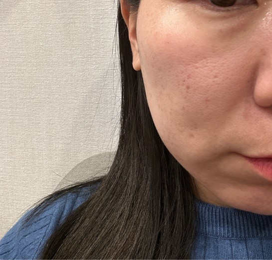 after photo: ララピール(LHAピーリング)