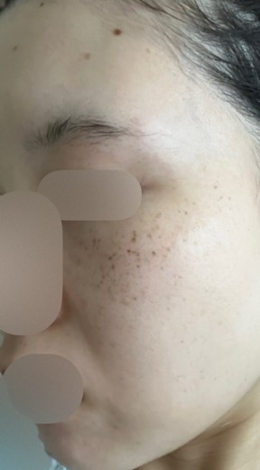 after photo: ルメッカ