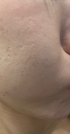 after photo: ダーマペン