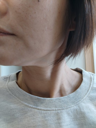 after photo: ピコトーニング