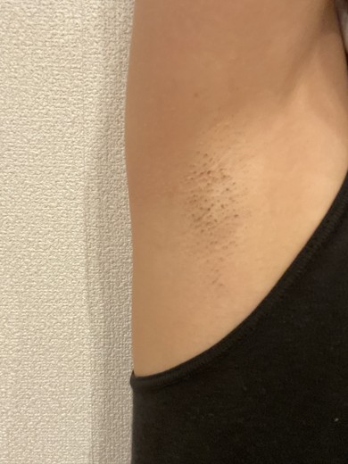 after photo: 脱毛(ワキ)