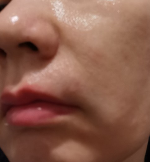 after photo: 脂肪溶解注射(顔)