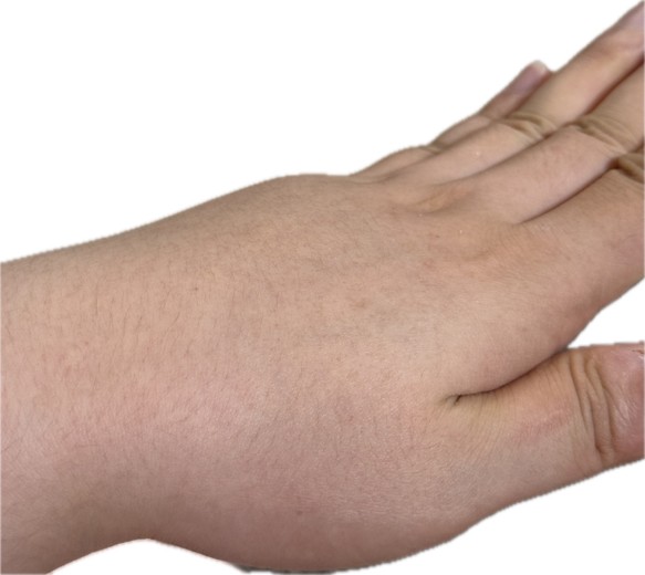 after photo: 팔지방흡입, 옆구리지방흡입, 복부지방흡입, 허리지방흡입