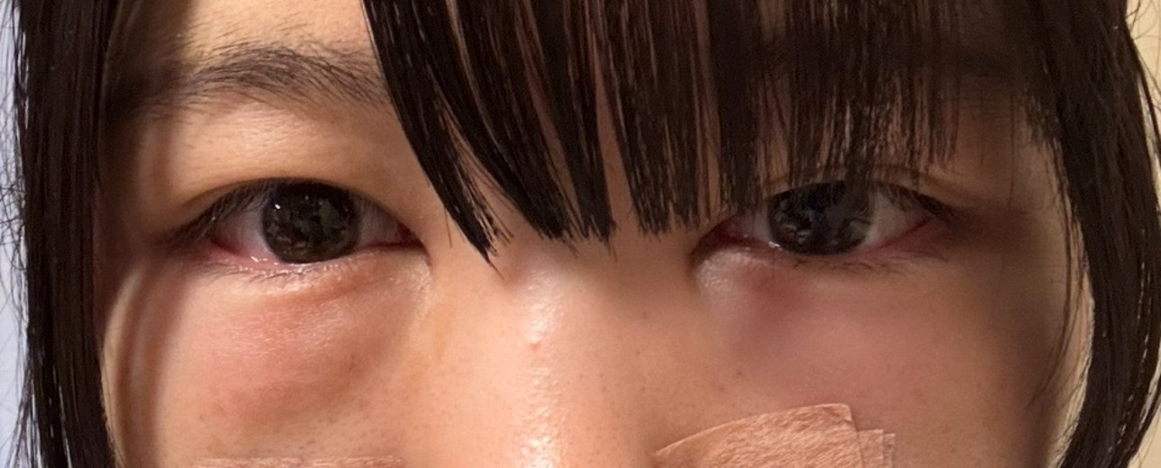 after photo: 目の下脂肪再配置(ハムラ・裏ハムラ法)