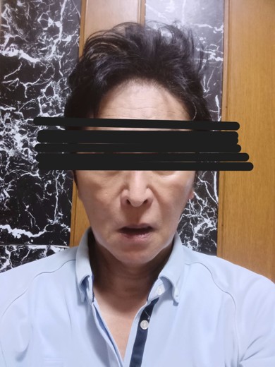 after photo: 脂肪溶解注射(顔)