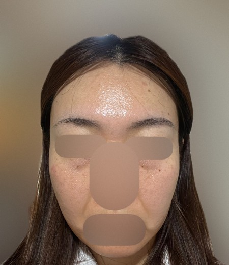 after photo: IPL(光/フォト治療), ピーリング, エレクトロポレーション