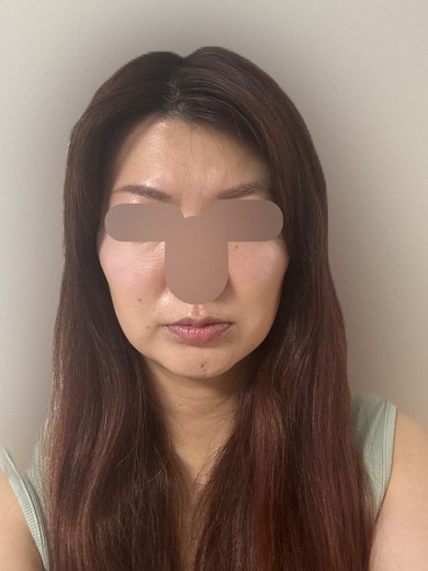 after photo: 脂肪溶解注射(顔)