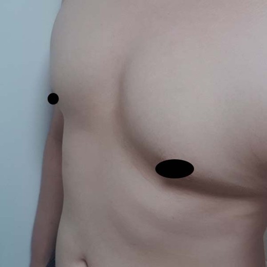 before photo: 여유증수술