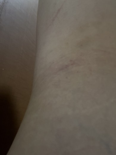 after photo: 脂肪冷却(脇腹), 脂肪冷却(お尻)