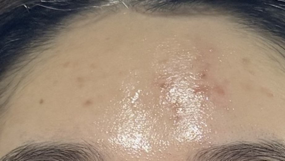 before photo: 스킨스케일링, 여드름압출, 여드름주사