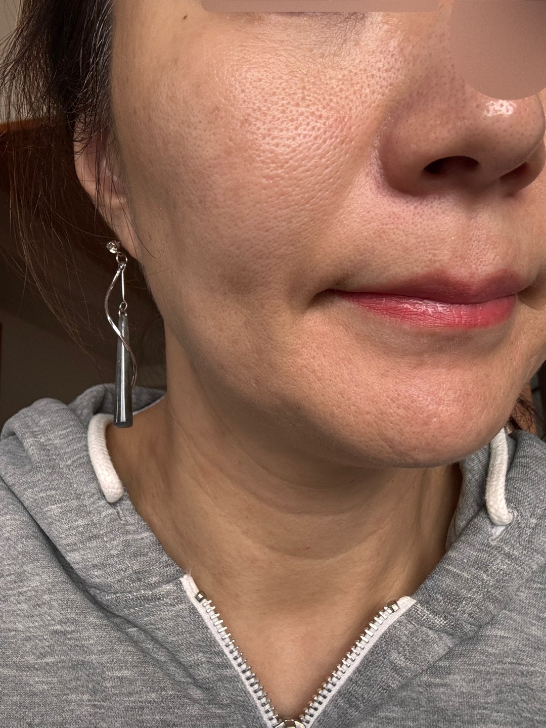 ハイドラフェイシャル＋ケアシス｜トラネキサム酸導入｜全顔 | こまち