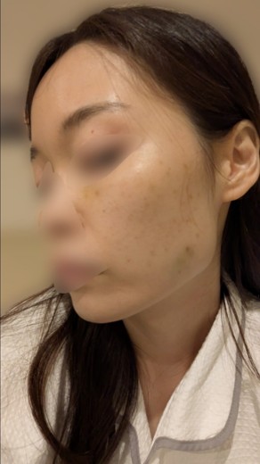 after photo: 脂肪溶解注射(腕), 脂肪溶解注射(太もも)