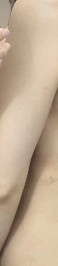 after photo: 脂肪溶解注射(腕)