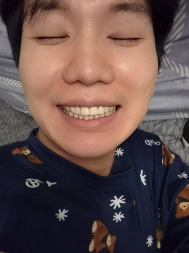 after photo: 턱제모, 인중제모