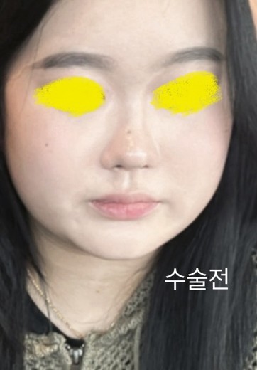 before photo: 콧대(보형물), 코끝(자가연골), 비후성비염수술