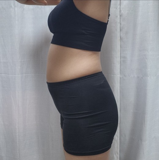 before photo: 복부지방분해주사, 팔지방분해주사