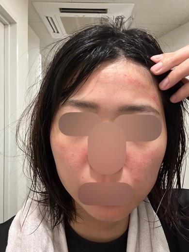 after photo: ダーマペン