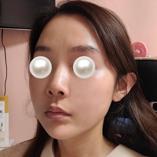 after photo: 울쎄라피프라임