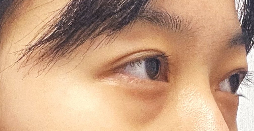 before photo: 눈밑지방재배치