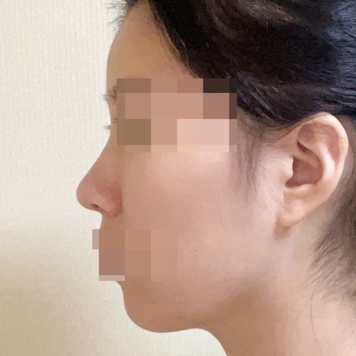 after photo: 코끝(자가연골)